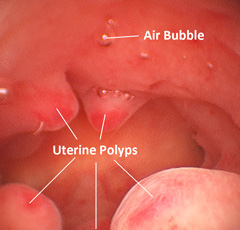 Office hysteroscopy revealing endometrial polyps