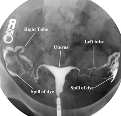 HSG X-ray Image: HSG Explained