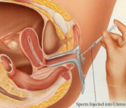 Medical illustration of how IUI is performed | Dallas IVF | Frisco & Dallas, TX