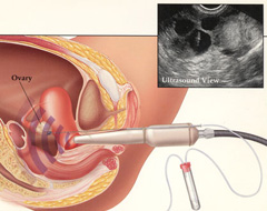 ivf retrieval