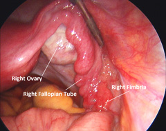 Normal right fallopian tube and ovary