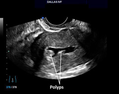 Saline Sonogram revealing endometrial polyp